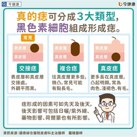 臉上為什麼會長痣|是痣？皮膚癌？還是什麼？常見Q&A解惑！醫教揪出「。